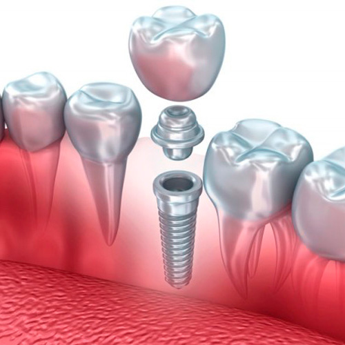 Implantes_dentales_01